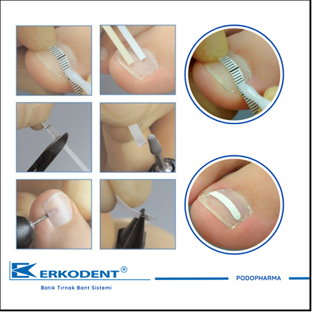 ERKODENT ONYCLİP BATIK TIRNAK BANT SİSTEMLERİ